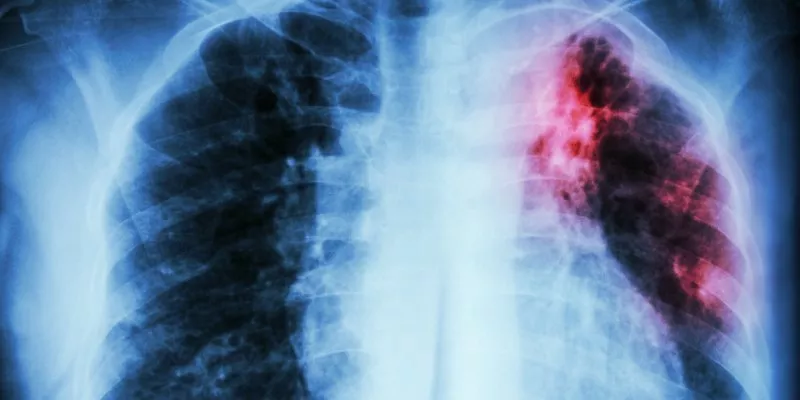 Avanza ley que busca mejorar el tratamiento de la tuberculosis en Colombia (Cámara)